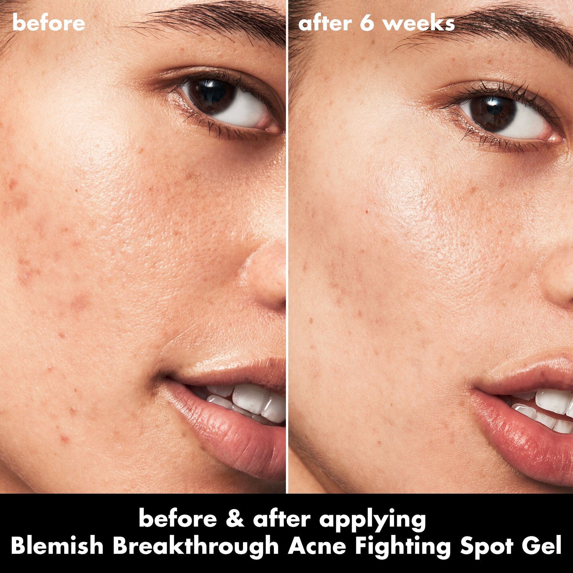 blemish-breakthrough-acne-fighting-spot-gel-c6 0326_EDU_BB_SpotGel_BA_ISABELLA.jpg