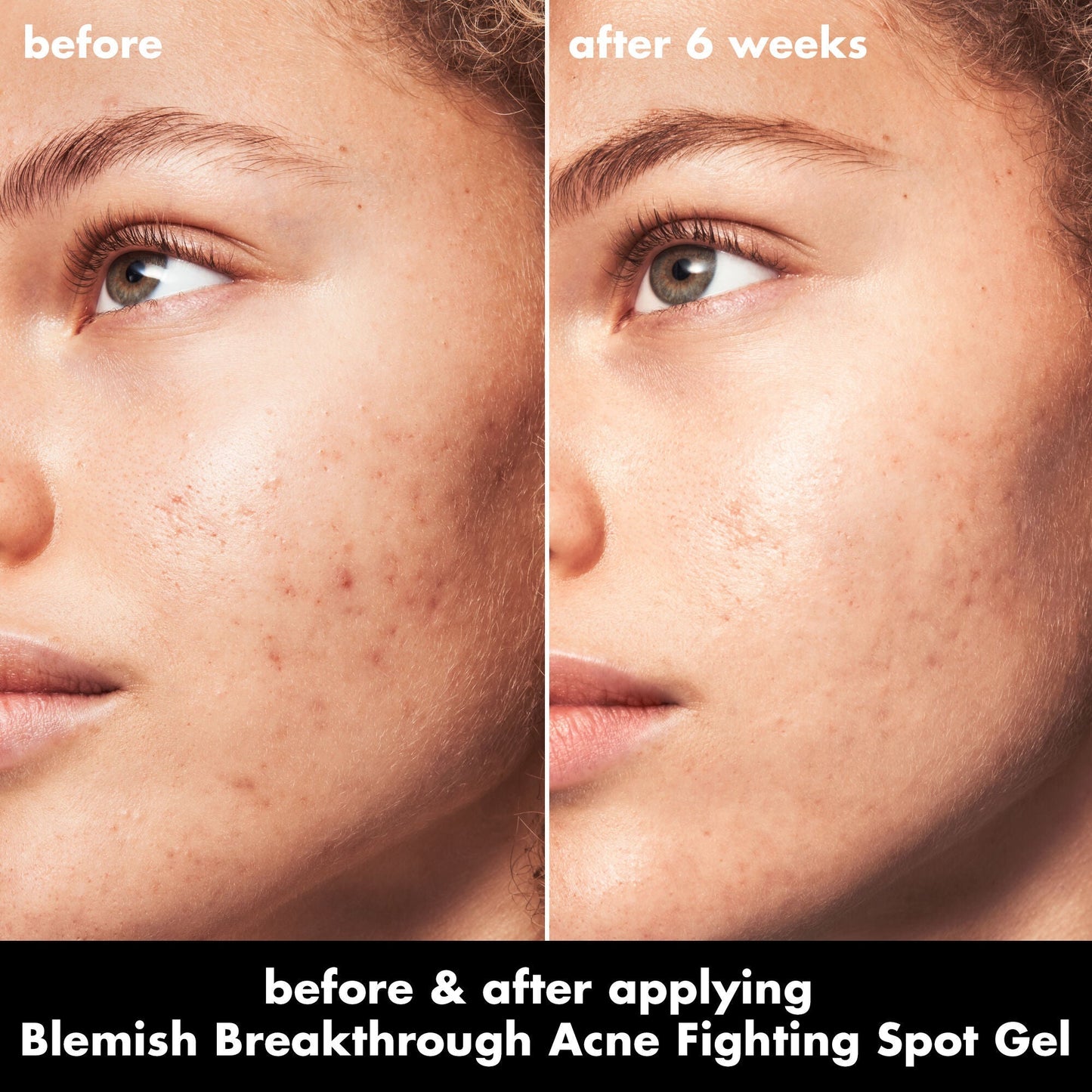 blemish-breakthrough-acne-fighting-spot-gel-c6 0326_EDU_BB_SpotGel_BA_MARLEY.jpg