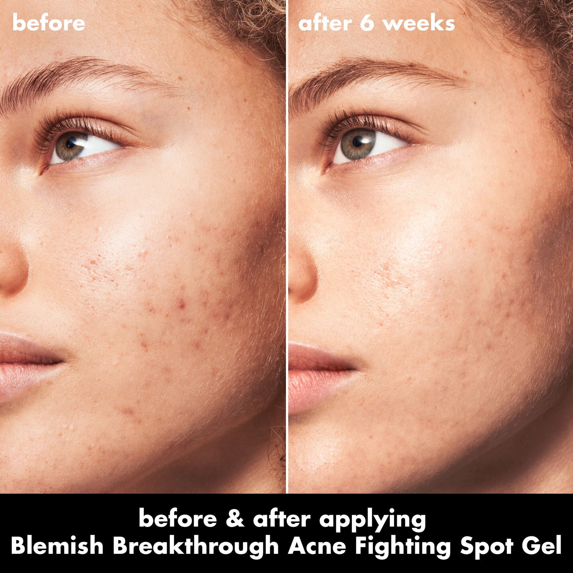 blemish-breakthrough-acne-fighting-spot-gel-c6 0326_EDU_BB_SpotGel_BA_MARLEY.jpg