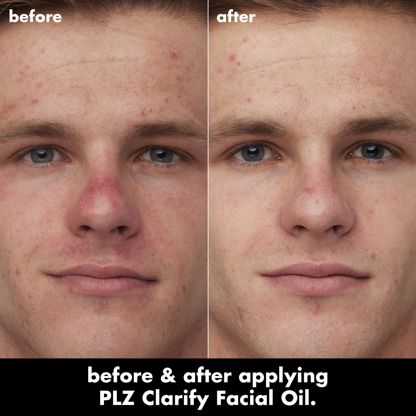 plz-clarify-facial-oil-h2 0326_EDU_PlzClarify_BA_Caleb.jpg