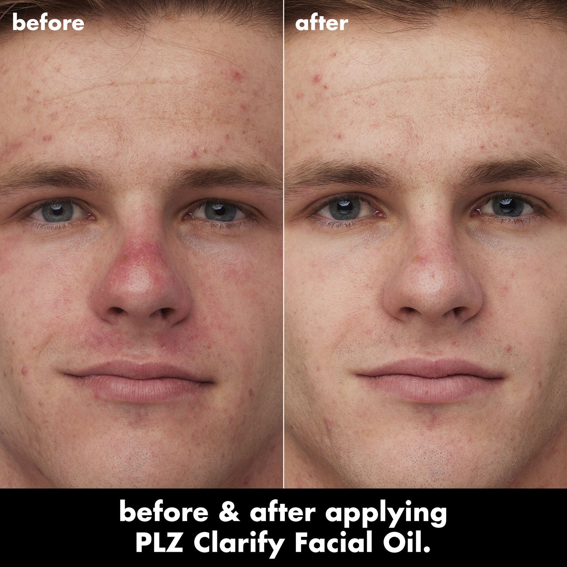 plz-clarify-facial-oil-h2 0326_EDU_PlzClarify_BA_Caleb.jpg