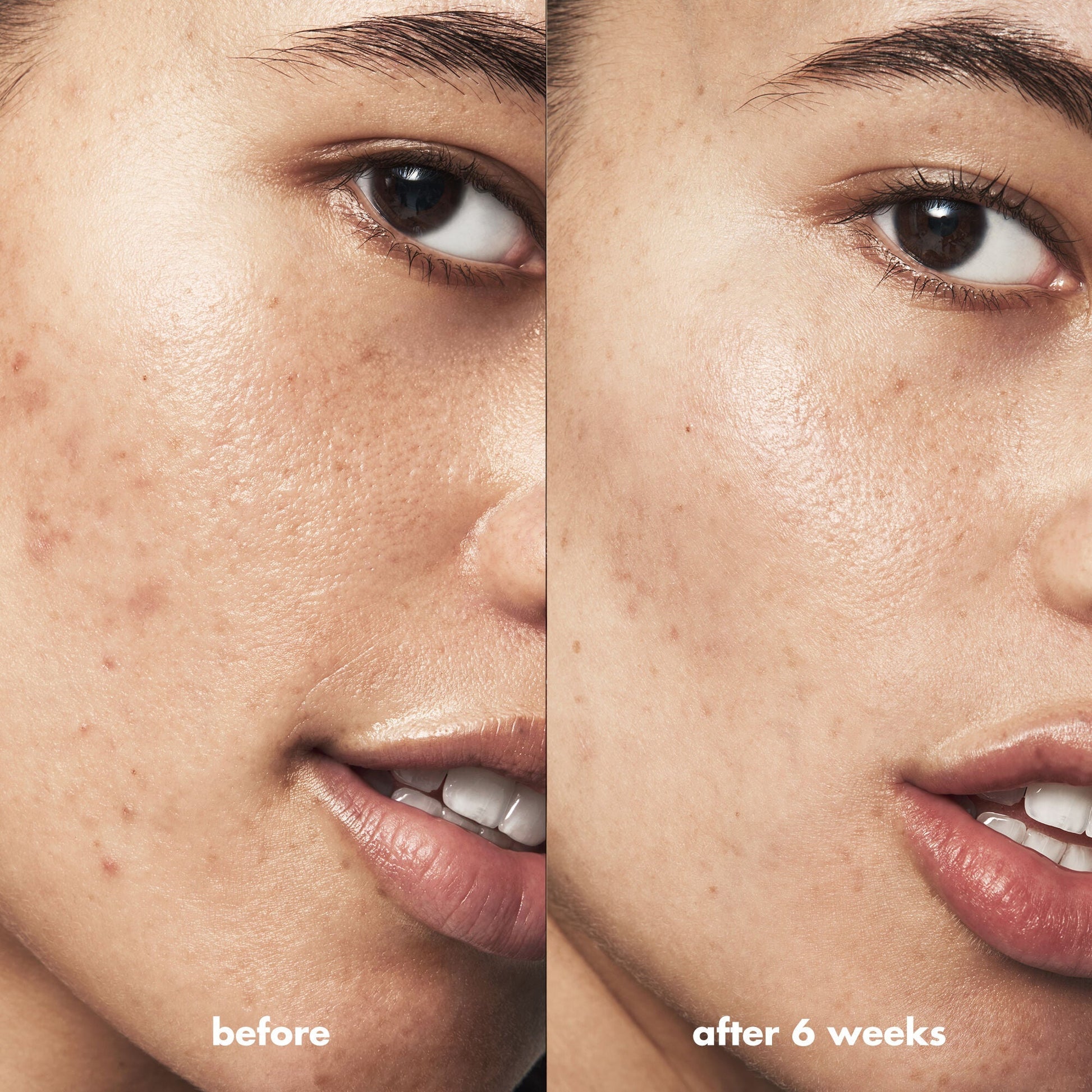 blemish-breakthrough-acne-calming-water-cream-mini-w5 Acne_PDP_Isabella_Before_After_f0d452cd-72f5-4bb8-a6df-0b3cc23143ef.jpg