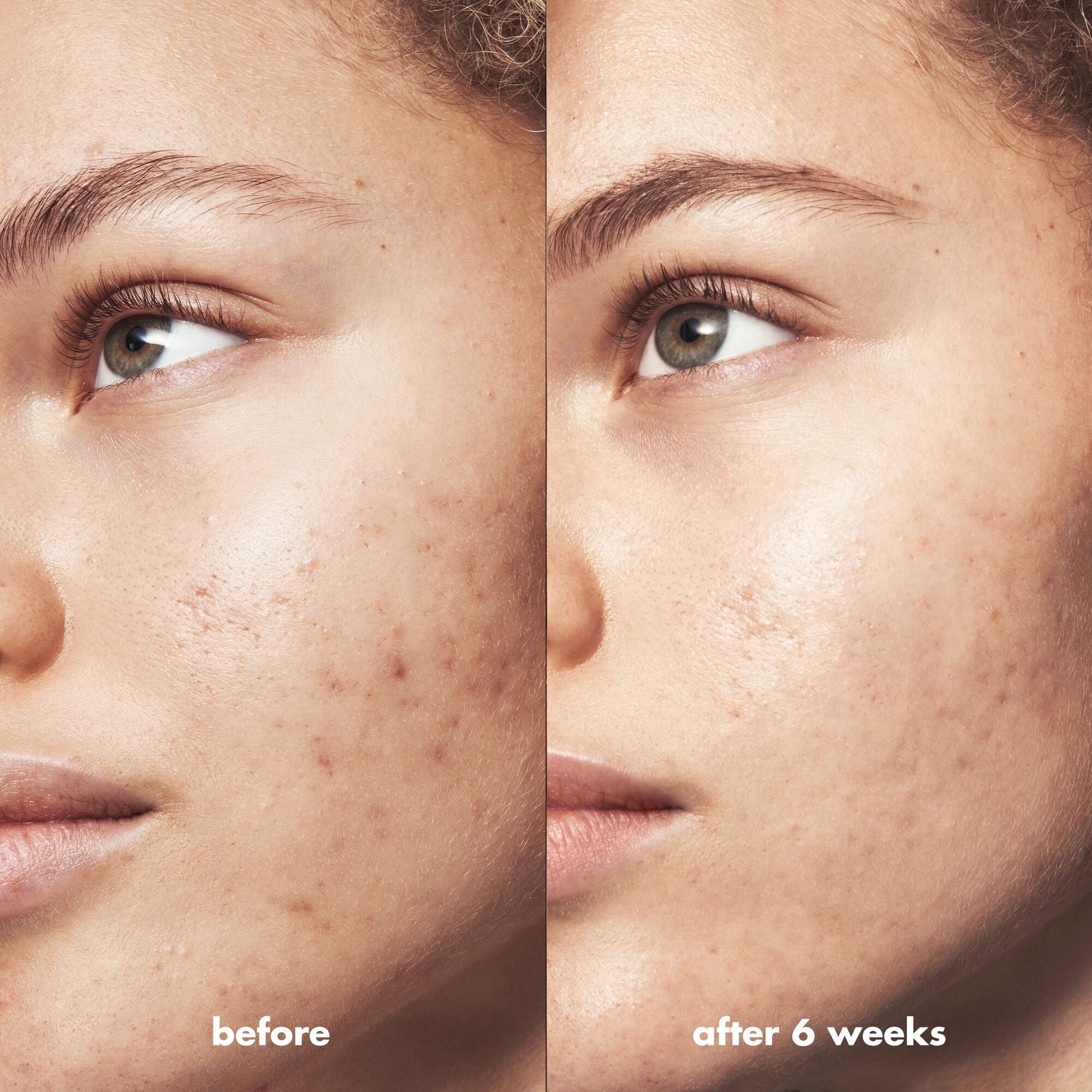 blemish-breakthrough-acne-clarifying-cleanser-f8 Acne_PDP_Marley_Before_After_216490cc-567c-424e-91eb-5374368f15d6.jpg